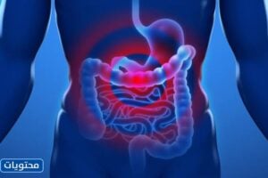 موقع متلازمة القولون العصبي