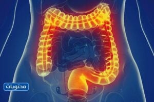 موقع متلازمة القولون العصبي